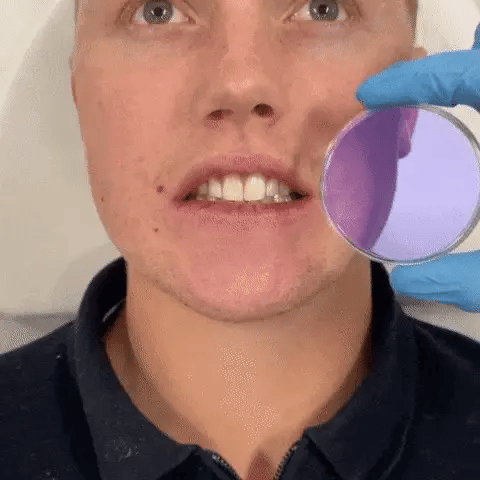 Clareador Dental Instantâneo Smilekit®