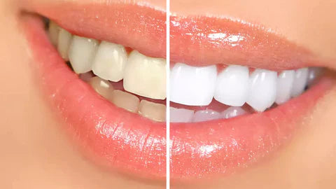 Clareador Dental Instantâneo Smilekit®